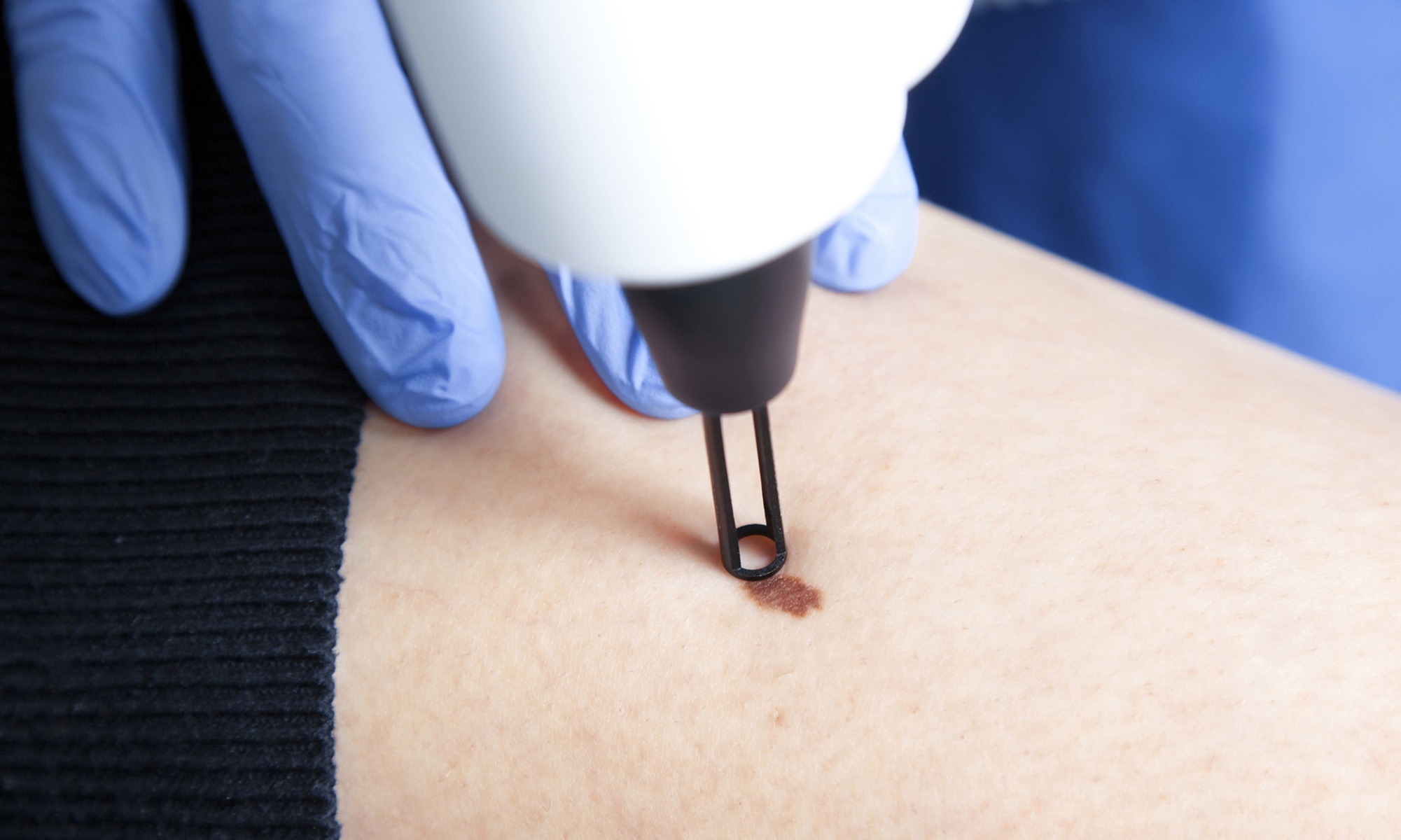 Smooth Skin with Five Skin Tags Removed, First Time Clients Only