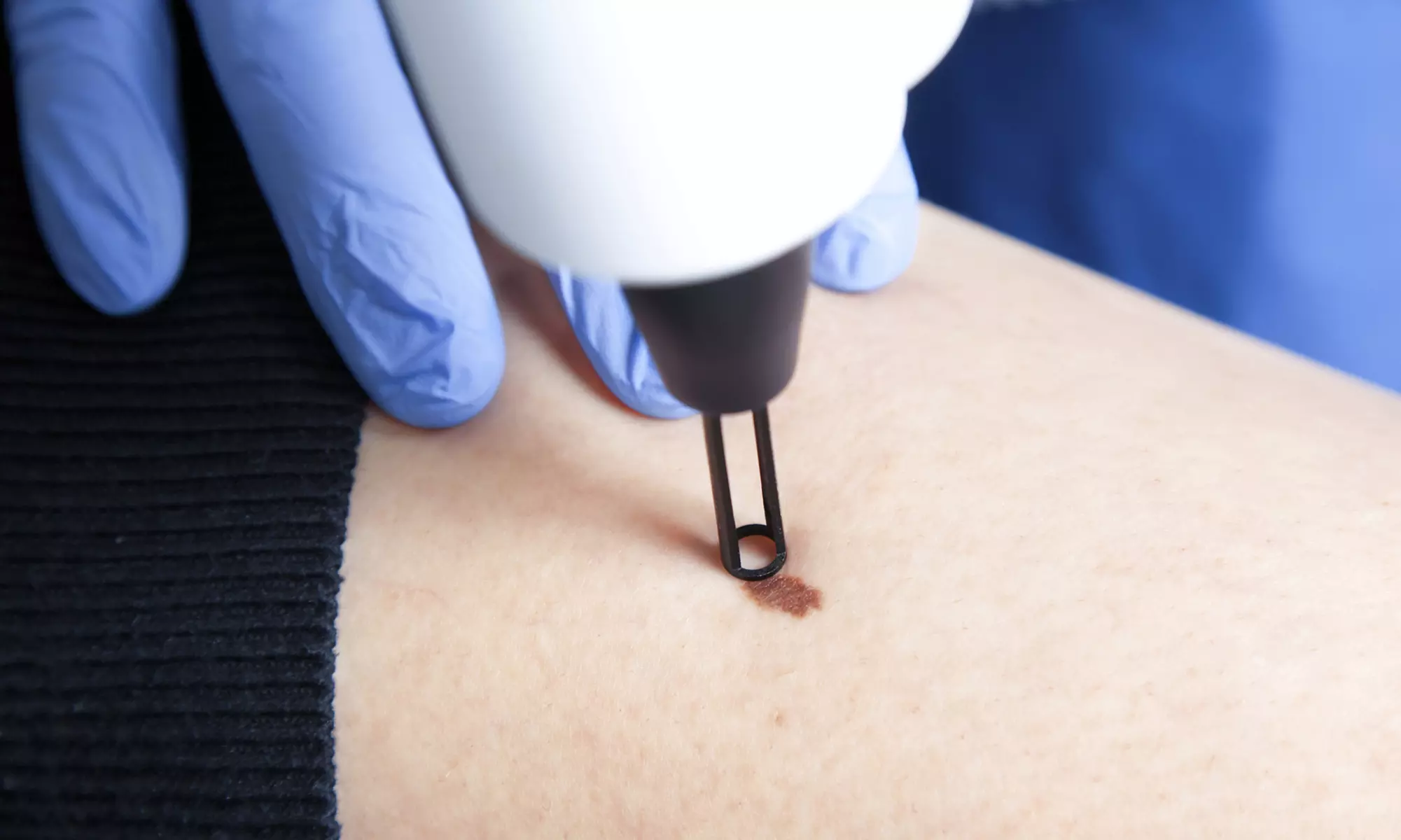 A and S Skin Care Offers 2, 3 or 5 Skin Tags, Cherry Angioma Or Sebaceous Hyperplasia Treatments (Up to 87% Off) - Primary Image