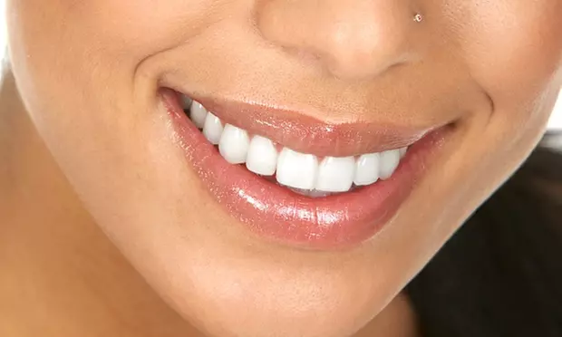Blanqueamiento dental en la clínica estética dental Clesdent