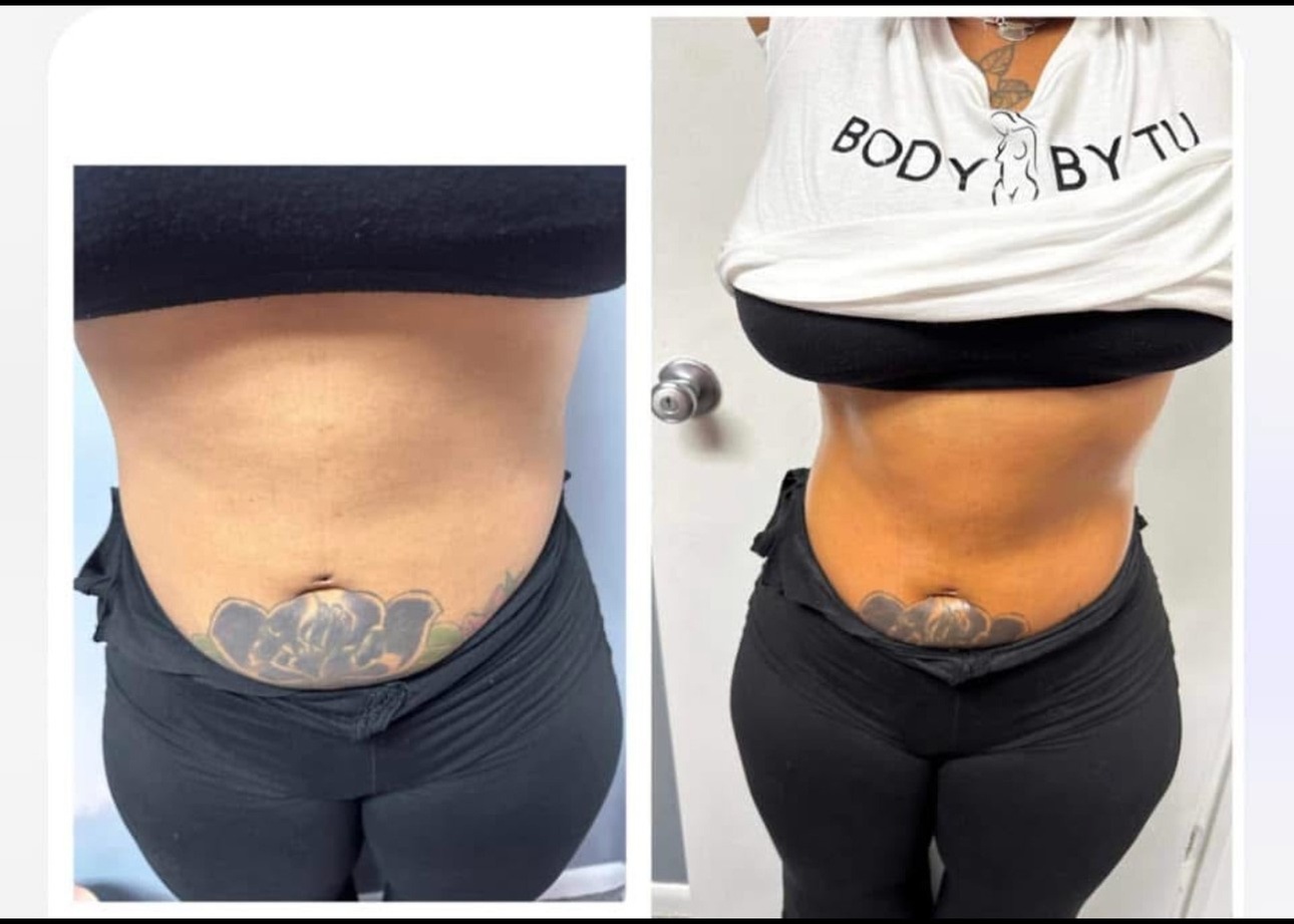 Up to 55% Off on Fat Reduction - Non-Branded at Body by Tu