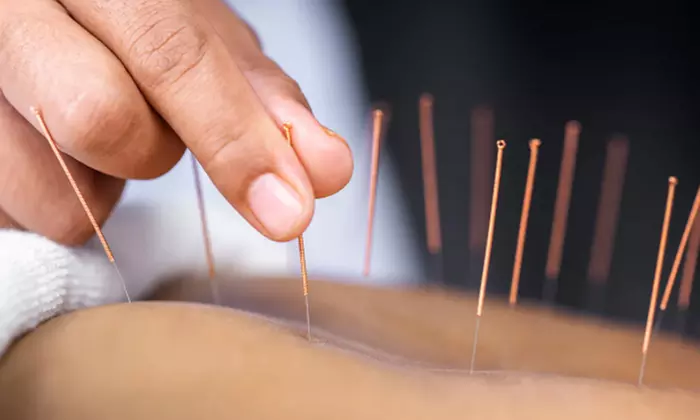 Up to 40% Off on Acupuncture at HOLISTIC ELITE - Primary Image