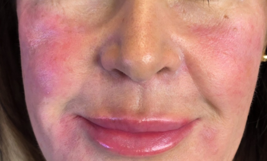 Image 7: Natural-Looking Rejuvenation with Evolysse & Lip Fillers
