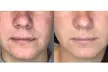 Revitalize with One Lumecca IPL Session for Full Face, Face and Neck or Face, Neck, and Chest ( Up to 47% Off ) - Second Medium