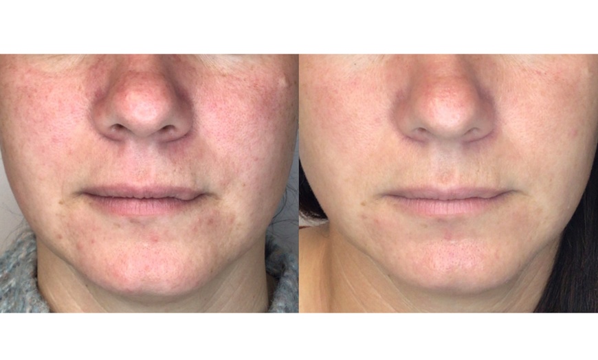 Image 5: Lumecca IPL Session for Full Face, Face and Neck or Face, Neck & Chest