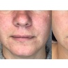 Image 5: Lumecca IPL Session for Full Face, Face and Neck or Face, Neck & Chest