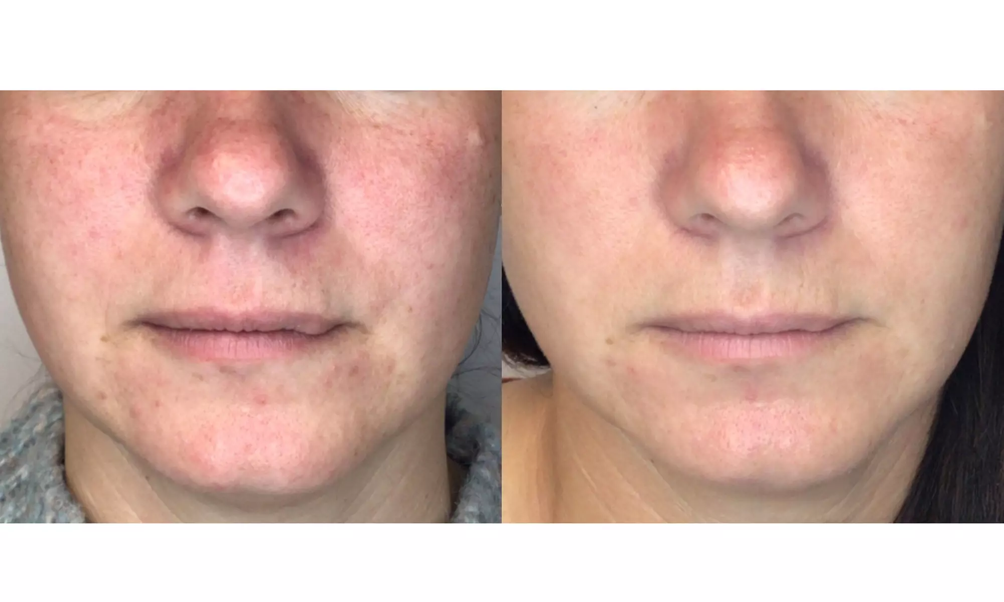 Lumecca IPL Session for Full Face, Face and Neck or Face, Neck & Chest