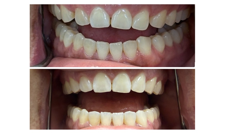 Image 3: Clear Aligner Teeth Straightening with Full Invisalign Package