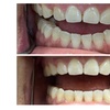 Image 3: Clear Aligner Teeth Straightening with Full Invisalign Package