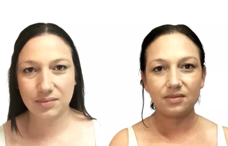 Non Surgical Face Lift with Optional Advanced Skin Tightening