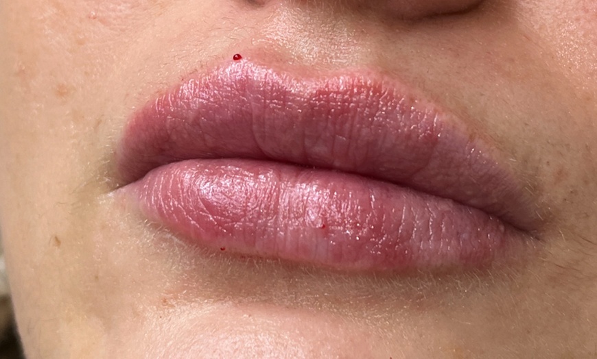 Image 5: Lip Enhancements with 0.5ml or 1ml Filler by UK-Qualified Experts