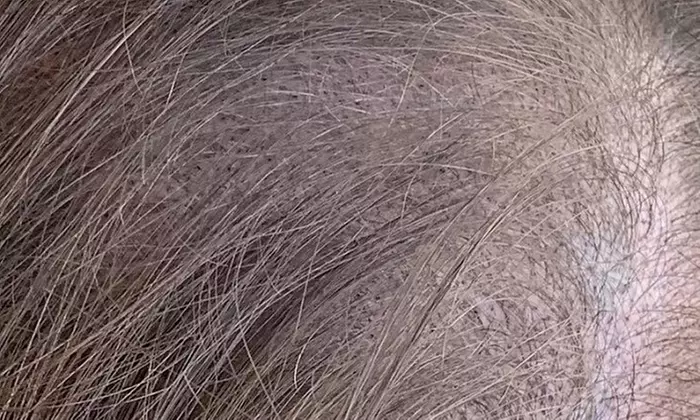 Scalp Micropigmentation