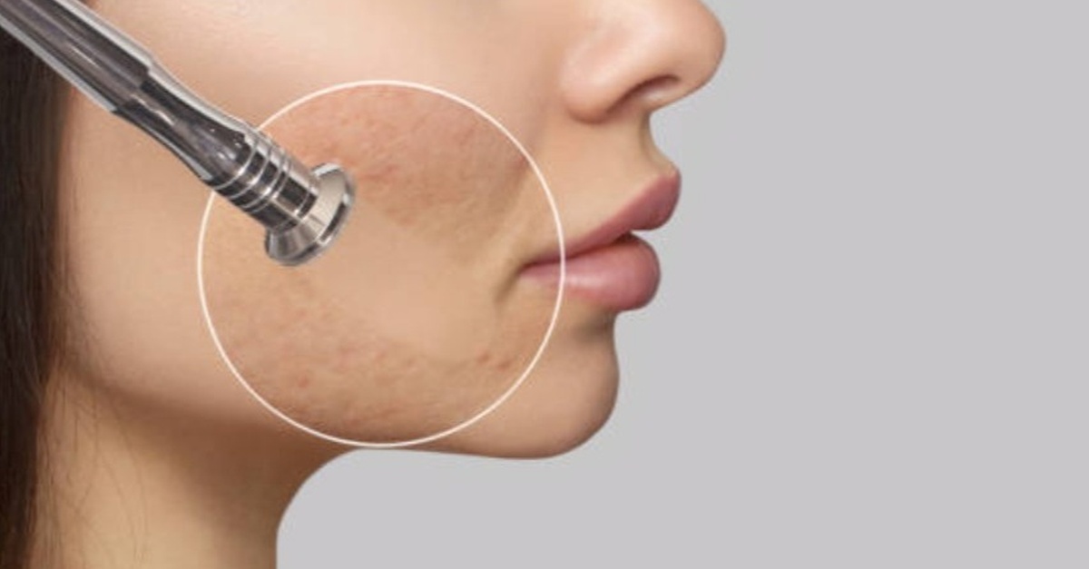Higiene facial con opciones de radiofrecuencia y máscara LED en Valencia