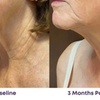 Image 3: Get Opus Plasma Treatment on Forehead, Hands, Face, or Face & Neck 