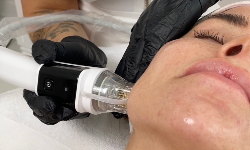 Image 1: Up to 40% Off on Micro-Needling at Bourne Beauty Laser Tattoo Removal