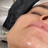 Image 1: Up to 40% Off on Micro-Needling at Bourne Beauty Laser Tattoo Removal