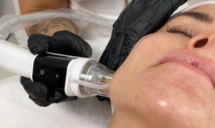 For 1 session: Radiofrequency Micro-needling For Full Face & Neck - Bourne Beauty Laser Tattoo Removal