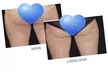 Complete 5-Month CoolSculpting Program Treatments for One at Elite Skin Studio's  - Up to 55% Off - Second Medium