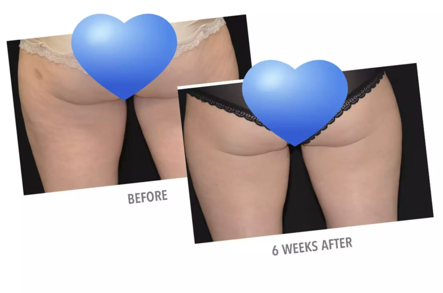 All-Inclusive CoolSculpting 5 Month Program -- One Price, Real Results!