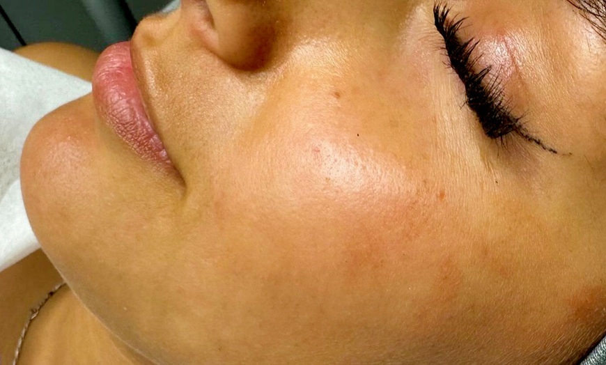 Image 2: Gesichtsreinigung / Aqua Facial / Microneedling / Microdermabrasion