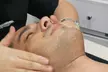 Limpieza facial para hombres en las Clínicas Láser Fusión Zaragoza - Image 3