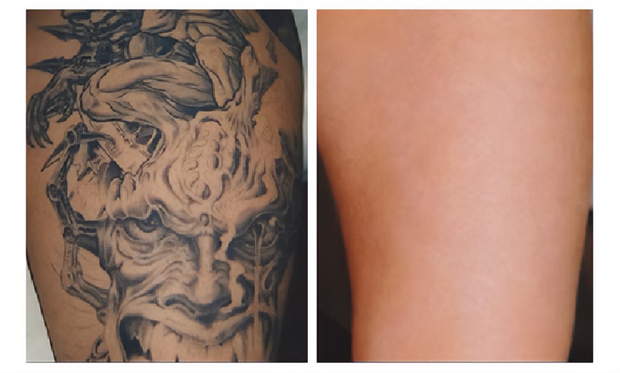Image 2: Laser Tattoo-Removal Sessions on an Area of up to 1 or 3  or 6 Square 