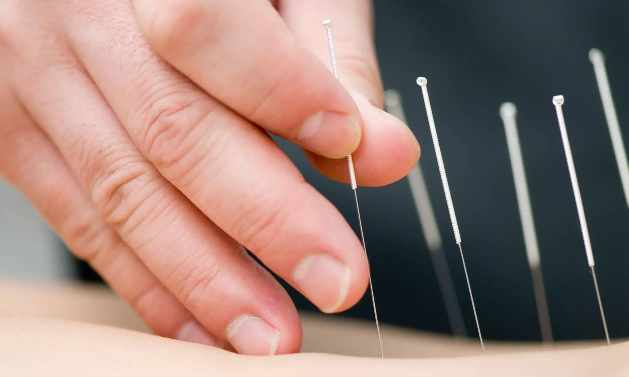 One or Three Acupuncture Treatments from Dr. Mark Jones in Joliet (Up to 69% Off) - Primary Image