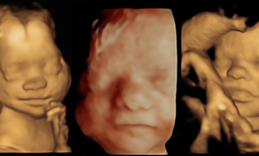 Image 3: Early Pregnancy Scan at Window To The Womb, Harlow