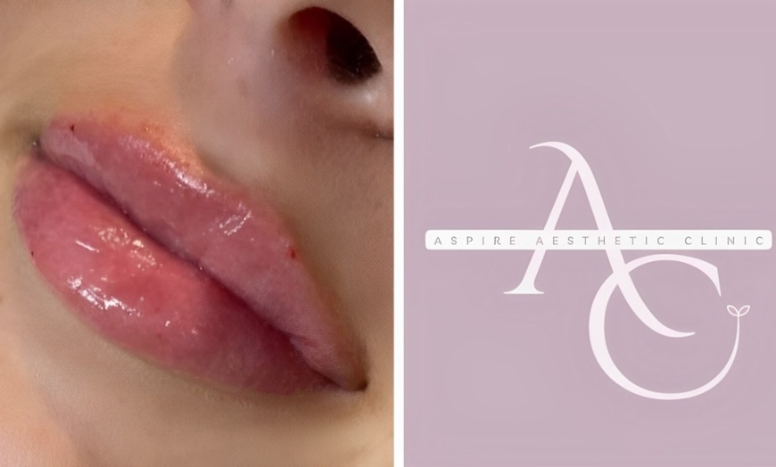 Image 5: Enhance your Lips with Expert Dermal Filler Treatments in Wembley!