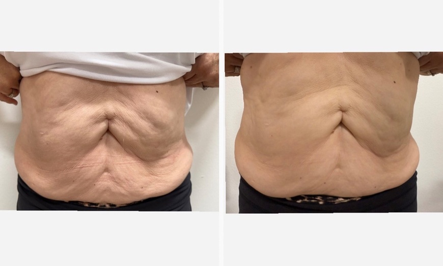 Image 7: Relax with Cryo & Thermal Body sculpting (2 or 3 sessions)