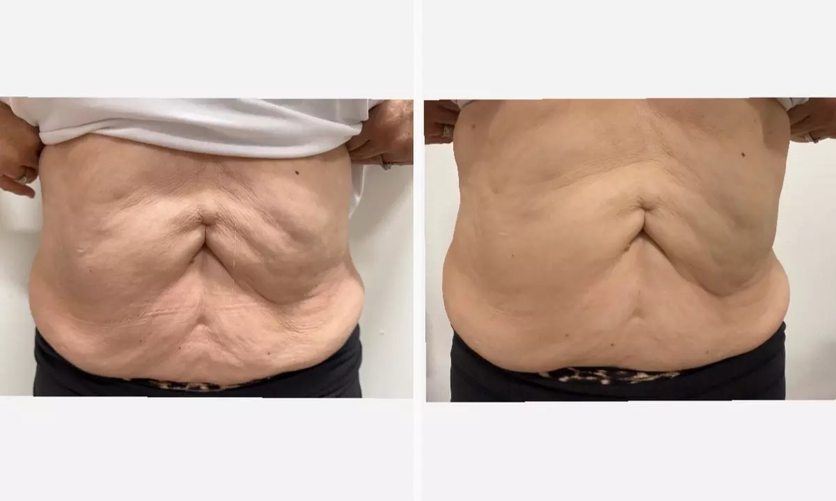 Relax with Cryo & Thermal Body sculpting (2 or 3 sessions)