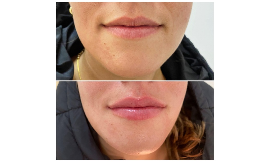 Image 5: ¡Infiltración de relleno dérmico con opción a blanqueamiento dental!