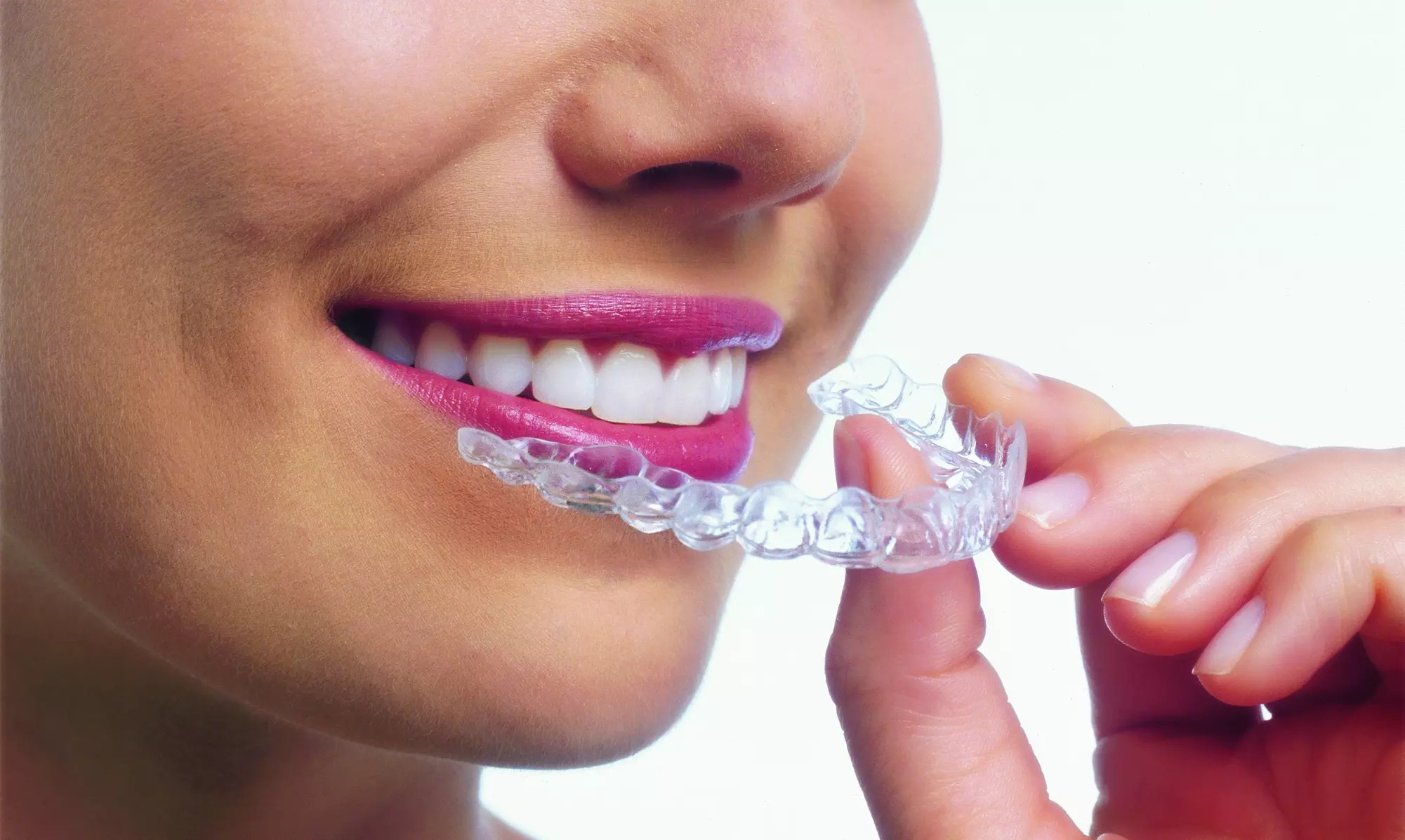 $20 for $1500 Towards an Orthodontic Exam and Invisalign at Shullman Orthodontics ($2,224 Value) - Primary Image