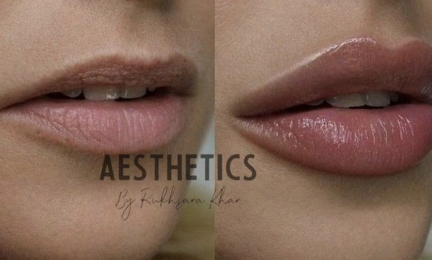 Image 1: Choose the Perfect Lip Filler for You with 0.5ml or 1.1ml Lip Filler