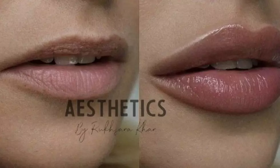 Choose the Perfect Lip Filler for You with 0.5ml or 1.1ml Lip Filler