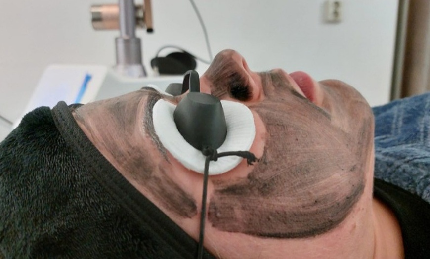 Image 8: Effectieve carbon laser peeling voor huidverjonging en collageenboost