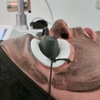 Image 8: Effectieve carbon laser peeling voor huidverjonging en collageenboost
