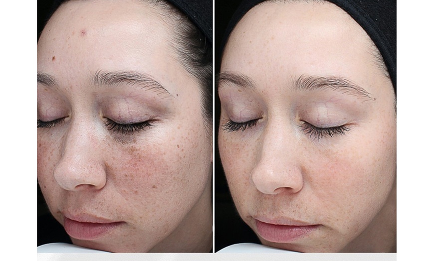 Image 2: VI Original, Purify or Advanced Peel with LED Light Therapy