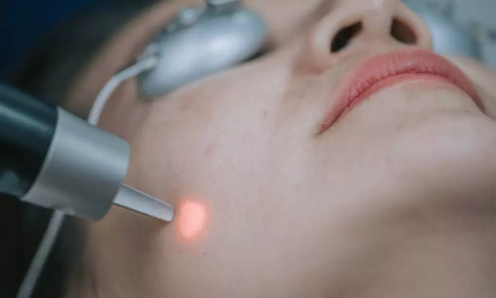 1 o 3 sesiones de láser facial para fotorrejuvenecimiento y manchas