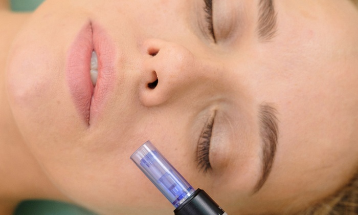 Bis zu 62% Rabatt auf Micro-Needling bei AGLAIA Beauty