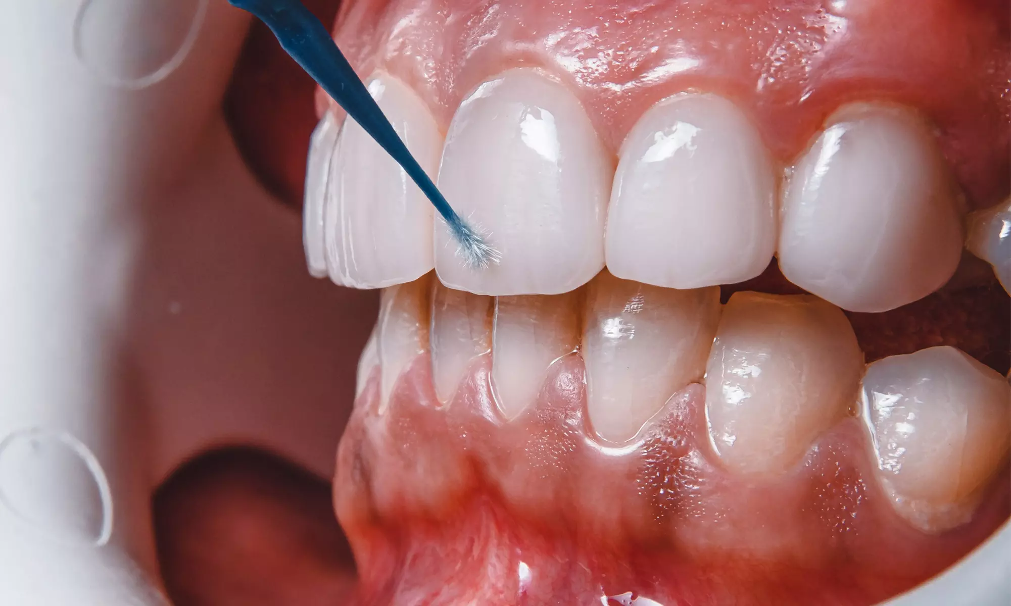 30 or 60-Minute Teeth Whitening Or 60-Minute Teeth Whitening for Two