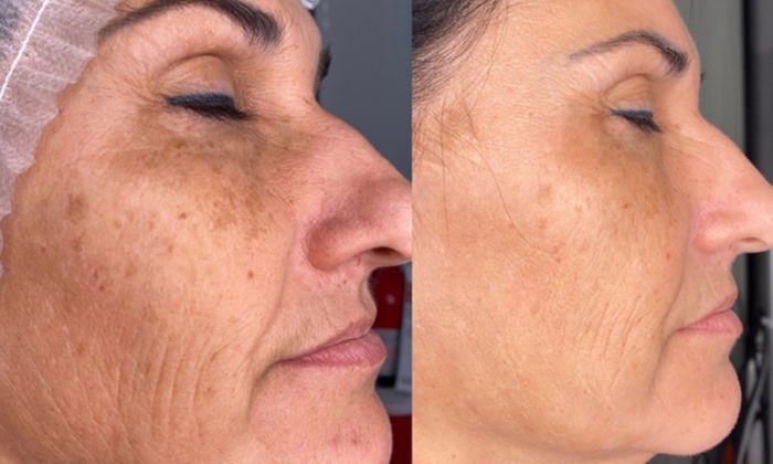 Experience Allure Infinite Beauty's rejuvenating treatments on full face or neck with up to 25% off.