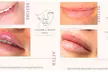 Perfect Your Pout with Dermal Filler - 0.5ml or 1ml  (Up To 60% Off) - Image 3