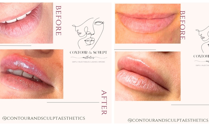 Image 1: Define Your Lips with Expertly Applied 0.5ml or 1ml Dermal Filler 