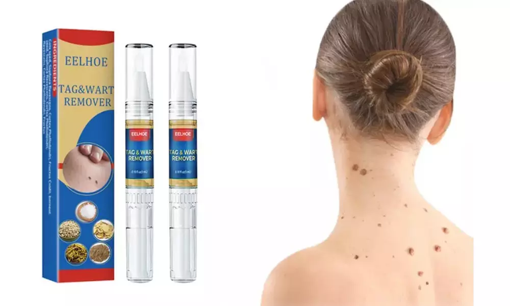 1x oder 2x Eelhoe Warzenentferner (3330€/1L)