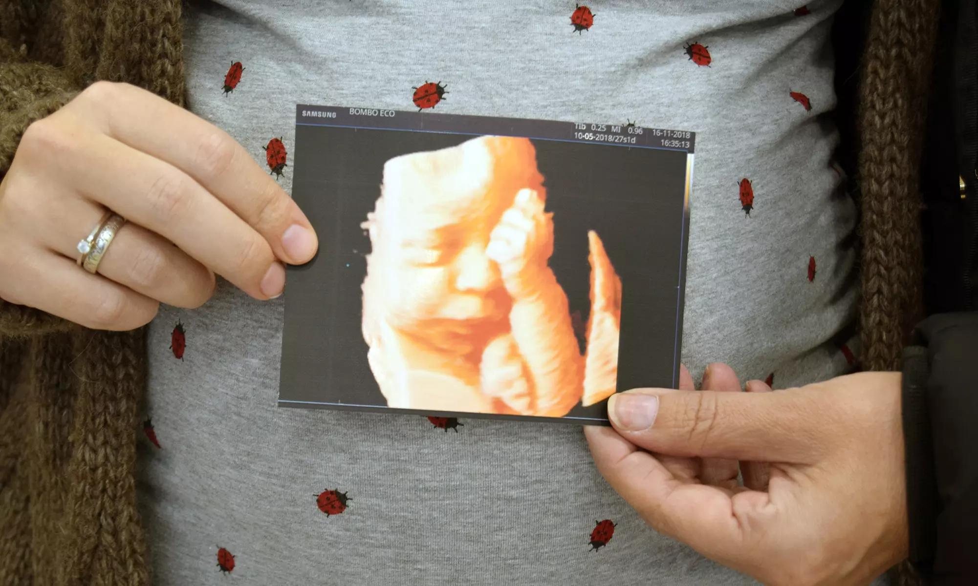 Conecta con tu bebé con 1 o 2 ecografías 5D con fotos y vídeos