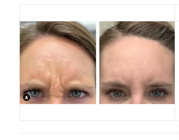 Revive Your Youthful Complexion with Botox