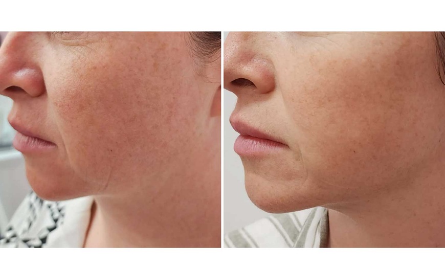 Image 2: Non-Surgical HIFU Chin Reduction, Face Lift with Neck Lift Add On!