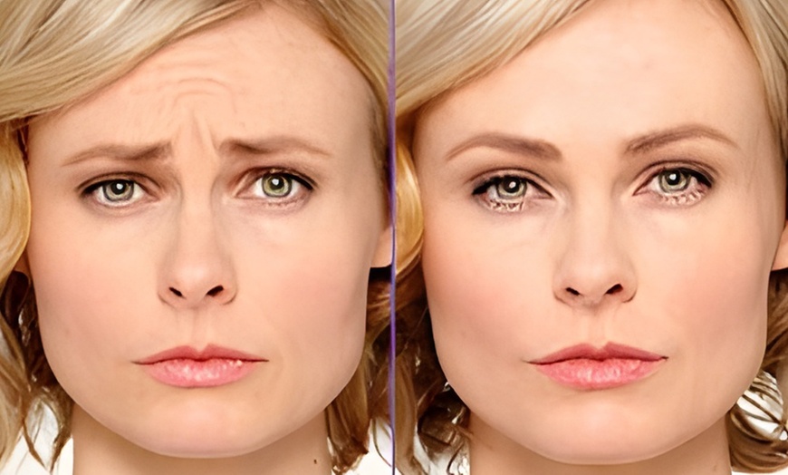 Image 3: Botox Treatments with Single or Two Sessions, or Botox Plus Restylane