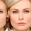 Image 3: Botox Treatments with Single or Two Sessions, or Botox Plus Restylane