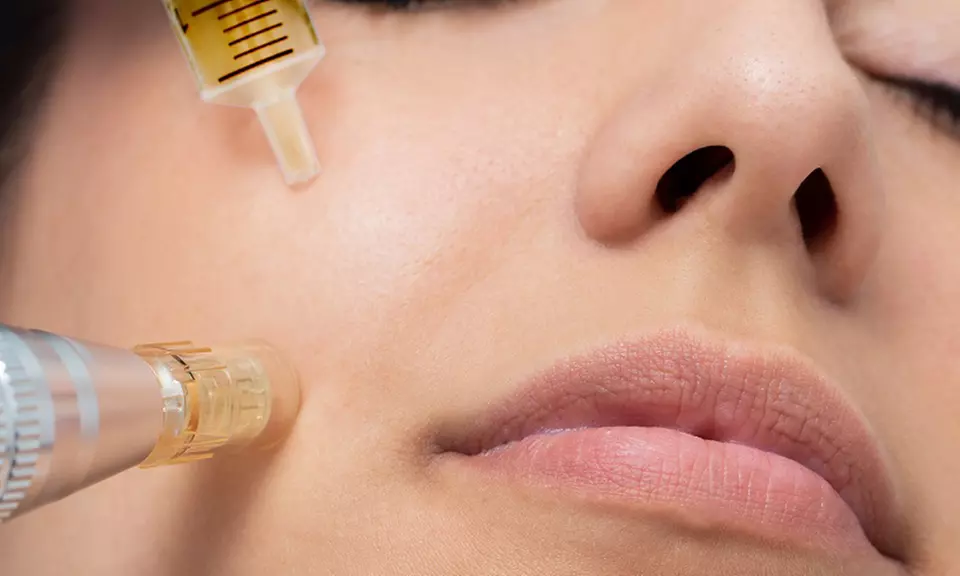 Splendida Salon and Spa offers Micro-Needling treatments with Hyaluronic Acid & Vitamins up to 28% off - Primary Image